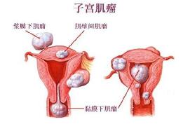 子宫肌瘤的症状-厦门天伦妇科医院