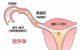 宫外孕的症状-厦门天伦医院妇科